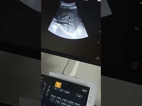 Doppler Ultrasound Diagnostic System US-C8D Cardiac Imaging Demonstration Video.