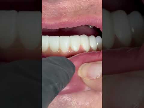 Lower Full mouth implants zirconia