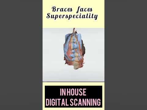 Revolutionizing Smiles with Braces Faces Super Specialty: In-House Digital Scanning #dentist #smile