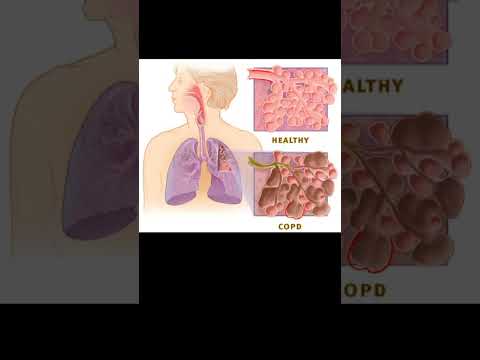 Ensifentrine (Ohtuvayre) for COPD: 2024 FDA Approval, ENHANCE Trials, and What You Need to Know