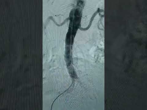 BeGraft Aortic Stent Graft